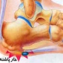 خار پاشنه را چگونه درمان کنیم؟