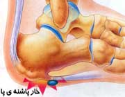 خار پاشنه را چگونه درمان کنیم؟