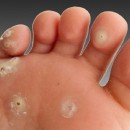 روش‌های گوناگون درمان میخچه